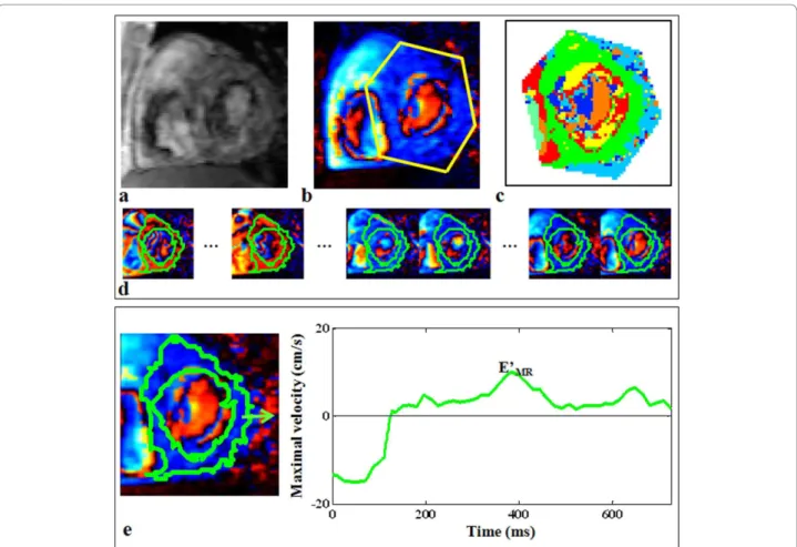 Figure 3 Example of longitudinal tissue velocity evaluation from a myocardial PC dataset