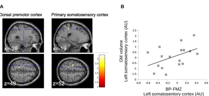 Fig. 3. Results of VBM analysis in regions of interest. A. Decrease of grey matter volume in the precentral gyrus, located in the dorsal premotor cortex (left panels) and the postcentral gyrus (right panels); p &lt; 0.001, with FWE correction at the level 