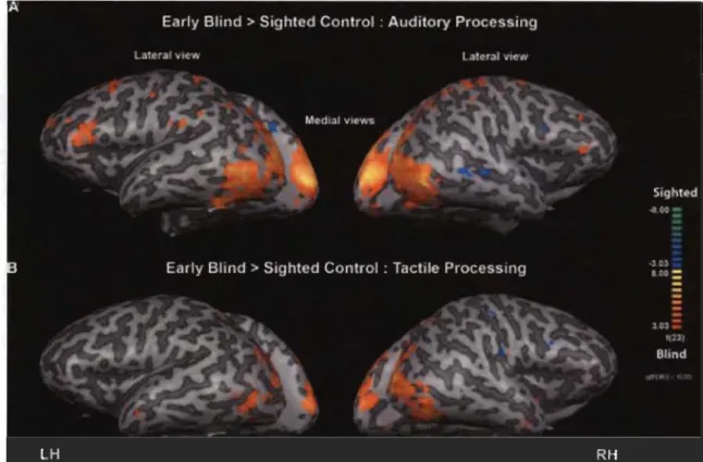 Figure 1.1  Patrons  d'activation  du  cortex  visuel  primaire  des  sujets  aveugles  précoces par des stimuli auditifs et tactiles