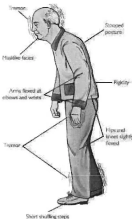 Figure 1.6  Signes cliniques menant au diagnostic de la MP. 