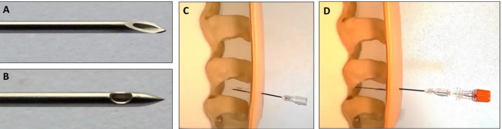 Fig 1. Illustration of atraumatic and cutting lumbar puncture needles. A: Pencil point (atraumatic) lumbar puncture needle