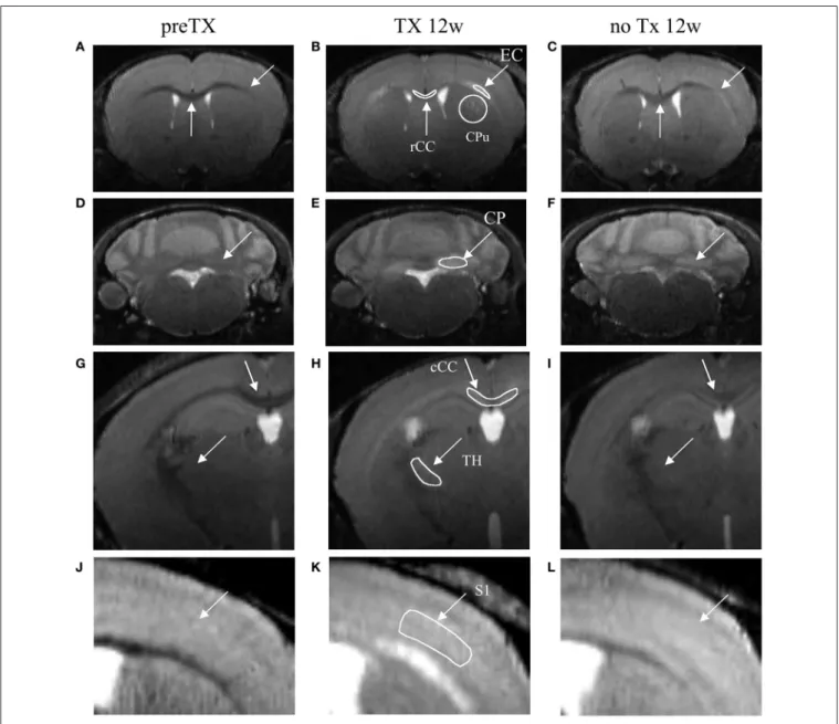 FIGURE 1 | T 2 -weighted coronal images of the dynamics of demyelination/remyelination over the course of the pre-TX (A,D,G,J), 12w TX (B,E,H,K) and 12w no TX phases (C,F,I,L)
