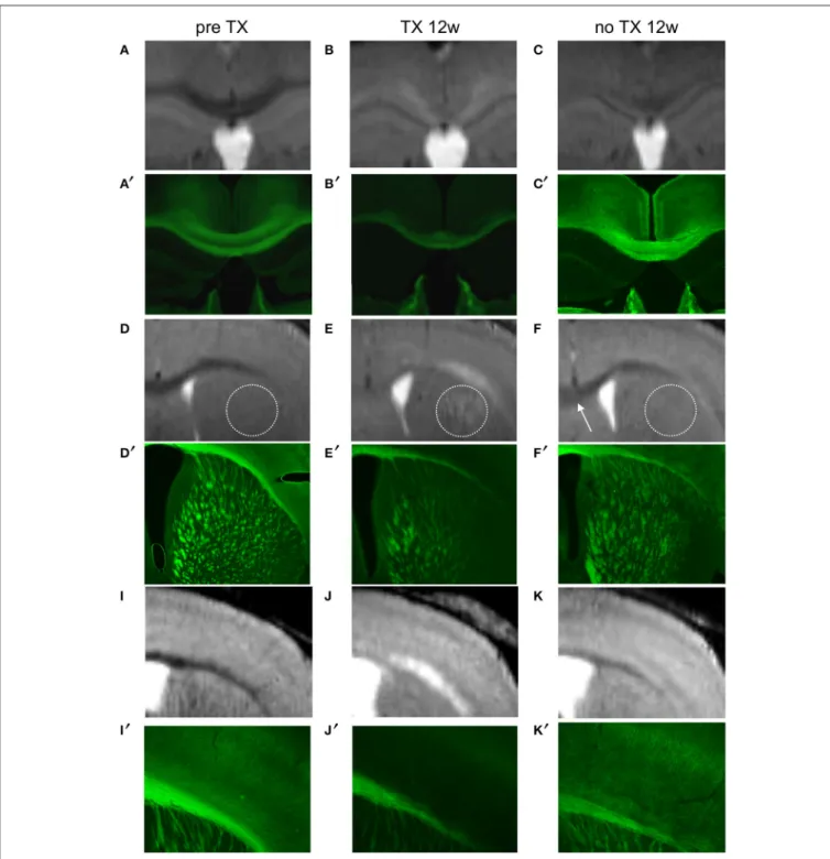 FIGURE 5 | Colocalization of demyelinated and remyelinated regions between MRI (A–K) and PLP/GFP immunohistochemical sections (A ′ –K ′ ) before TX, 12 weeks (12w) after TX, and 12 weeks after TX removal