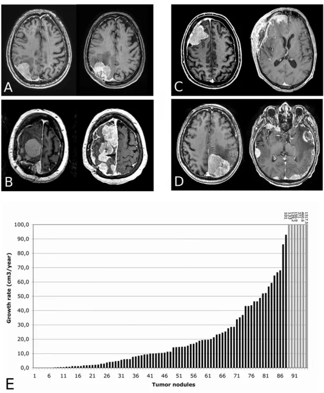 Figure  1.  Patterns  of  relapse  in  surgery-  and  radiation-refractory  meningiomas