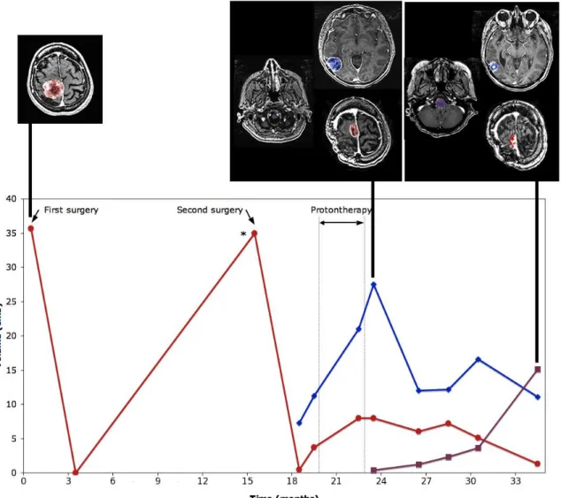 Figure  3.    Patterns  of  treatment  failure  in  surgery-  and  radiation  refractory  meningiomas:  distant  CSF  dissemination