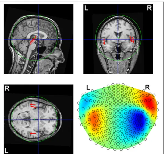 Figure 6 Simulated ECD locations. Like in figure 1 but with the additional (third) ECD in the right auditory cortex.
