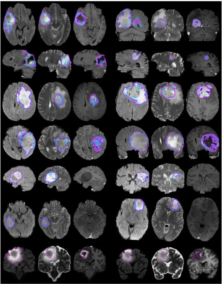 Fig. 2. Examples from the BRATS training data, with tumor regions as inferred from the annotations of individual experts (blue lines) and consensus segmentation (magenta lines)