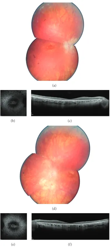 Figure 1: Ophthalmic features of family F752: II.1 (CIC01245): fundus color photographs ((a) and (d) for right and left eye resp.), autofluorescence ((b) and (e) for right and left eye resp.), and spectral domain optical coherence tomography horizontal mac