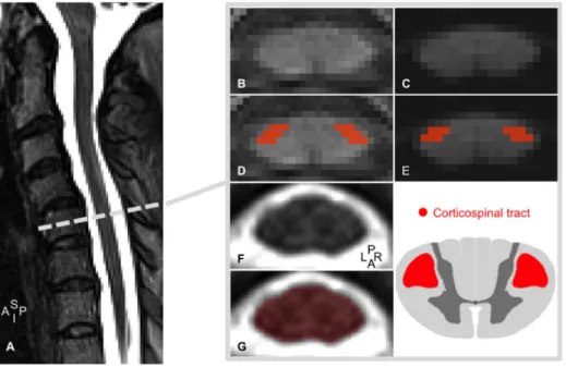 Figure 1. Regions of interest definition. (A) T2-weighted MRI mid-sagittal slice for an ALS patient