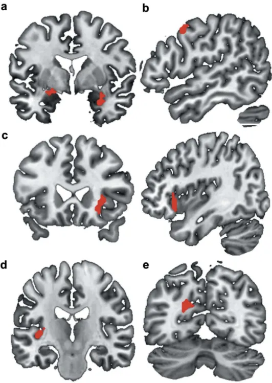 Figure 2. Brain representation of the significant clusters for the EMDR group (T1 (E1(CS+ vs CS-)-E6(CS+ vs CS-)))-T0(E1(CS+ vs CS-)-E6) minus wait-list group (T1 (E1(CS+ vs CS-)-E6(CS+ vs CS-)))-T0(E1(CS+ vs CS-)-E6) contrast