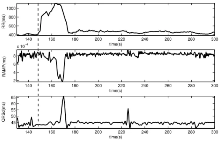 Fig. 4. Example of time series extracted from test real data. The annotated onset of the AB event is shown by dashed grey line.
