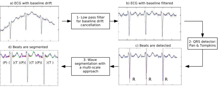 Fig. 2. The three stages of the ECG wave segmentation process. The segmentation of each wave is graphically represented in d) using the following notations: