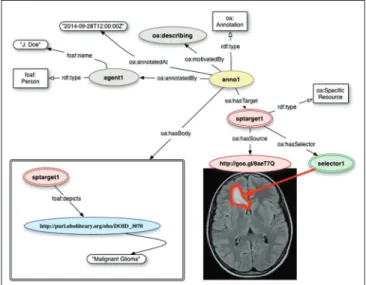 Figure 1: Using the Open Annotation (OA) model to annotate  a magnetic resonance image depicting the brain of a pediatric  patient with a diffusive glioma