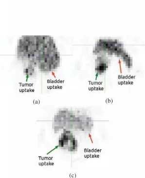 Figure 1: Three examples of PET acquisition of locally-advanced cervi- cervi-cal cancer, demonstrating a continuum uptake between tumor and  blad-der hyperﬁxation
