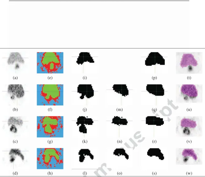 Figure 9: Example of BMA detection results for four patients. (a)-(d) Original PET exams