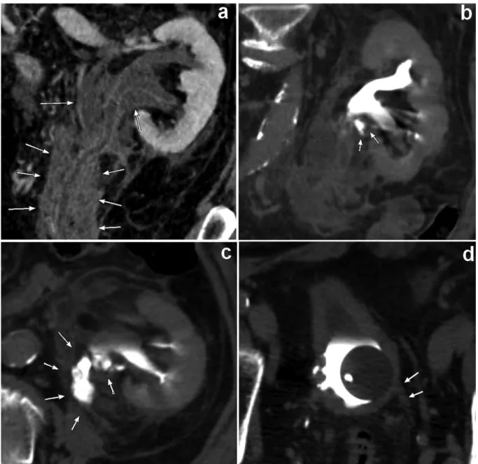 Fig.  1.  Vue  coronale  du  scanner  au  temps  veineux  (a)  montrant  un  épanchement  liquidien  péri- péri-uretéral gauche (flèches)