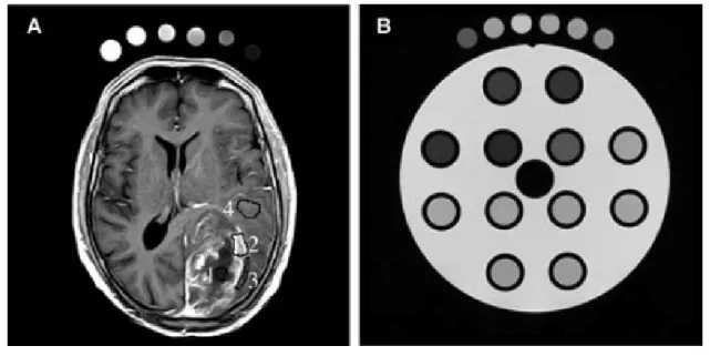 Fig. 1 Fig 1. (A) Postcontrast brain MR image from T1 dynamic series in axial plane. The four regions of the glioblastoma are labeled: (1) necrosis, 