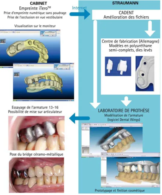 Figure 3 : Chaîne prothétique utilisant le système iTero™ pour la réalisation d’un bridge céramo- céramo-métallique