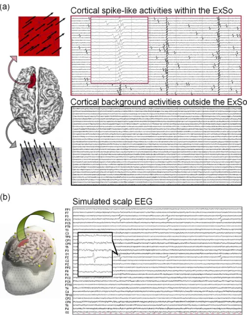 Figure 3: Simulation of scalp EEG spikes. (a) An extended source of 1000 triangles ( ≈ 10 cm 2 ) was manually dened on a mesh of the cortical surface using Paraview (Paraview, Kitware Inc., NY, US).