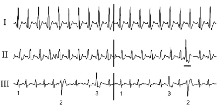 Fig. 3. Example of signals (one derivation of ECG) of Type I, Type II and Type III.