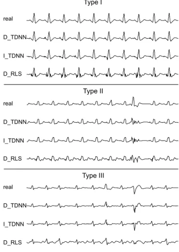 Fig. 7. Examples of synthesized ECG (lead DI) for a patient of each of the three types, using two bipolar EGM.