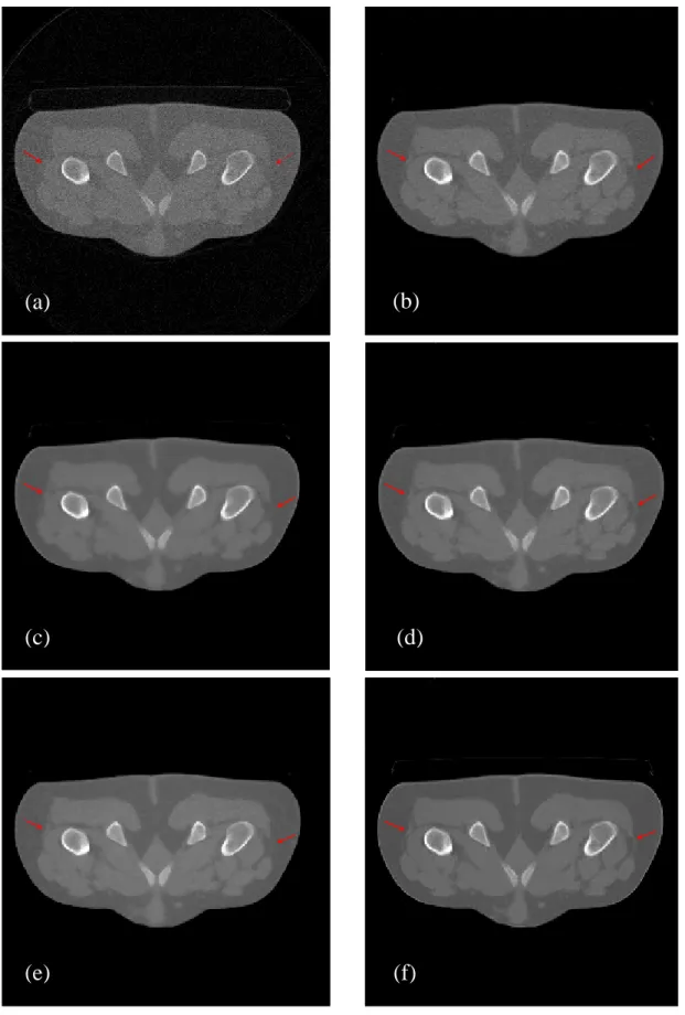 Fig. 6. FBP and Bayesian reconstructions using different priors for clinical pelvis data