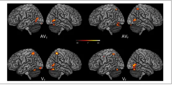 Figure 5. Surface rendering of brain regions activated showing correlation between visual RTs and neural activity in the  audio-visuo-facial (AV F ),  audio-visuo-lingual (AV T ), visuo-facial ( V F ), and visuo-lingual ( V T ) conditions ( p &lt; .05, FWE
