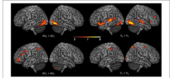 Figure 3. Surface rendering of brain regions activated showing significant change in activity between visual conditions related to lip and tongue movements ( V F &gt; V T and V T &gt; V F ) and audiovisual conditions related to lip and tongue movements (AV