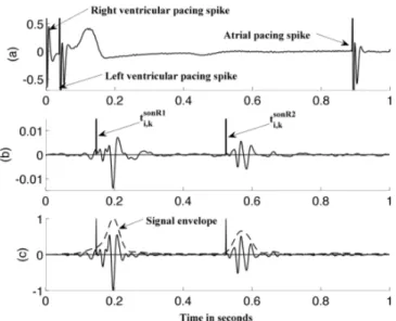 Fig. 1. Surface electrocardiogram (ECG) and mechanoacoustic (SonR) signals obtained from a CRT recipient during bi-ventricular pacing