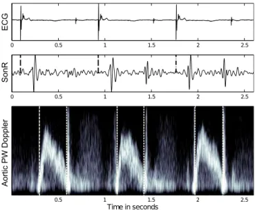 Fig. 2. Synchronous ECG (top panel), raw surface SonR (middle panel) and pulsed Doppler signal at the aortic site (lower panel), showing three beats from a record of the database