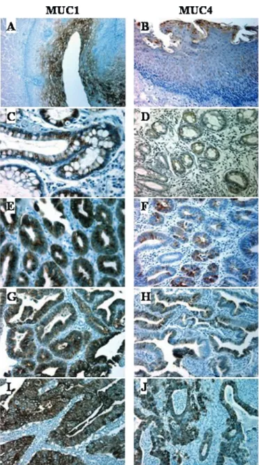 Figure 1 Expression of MUC1 and MUC4 apomucins during the progression of Barrett-associated oesophageal adenocarcinoma.