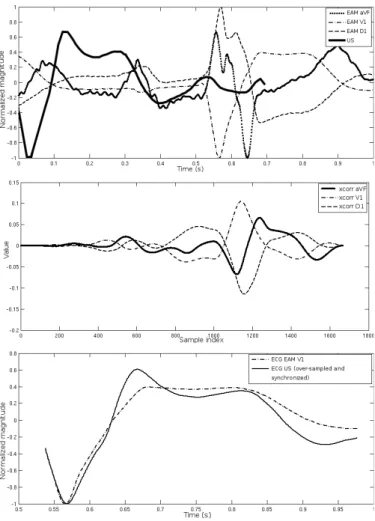 Fig. 4. Reference signal selection and synchronization. Top: ECG signals before synchronization: one derivation acquired during the US-STE  acquisi-tion and three derivaacquisi-tions from EAM (D1, V1, aVF)