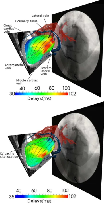 Fig. 5-bottom shows the result of the EAM/CT registration and enables to compare the first activated LV region with the identified pacing lead position in the lateral vein (encircled).