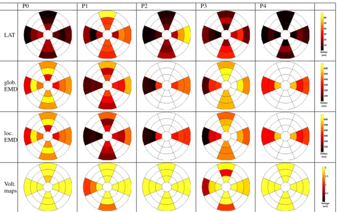 Fig. 10. 12 segments bull’s-eye visualizations of LAT (ms), global and local EMD (ms) and voltage maps (mV) (in rows), for the five patients of this study (in columns).
