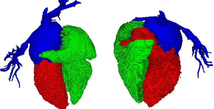 Figure 4 : Illustration d'une situation de compétition pour la segmentation de l'oreillette gauche, visualisation 3D des  structures extraites (avec une partie du réseau vasculaire associé) : VD (en vert), VG (en rouge), OG (en bleu)