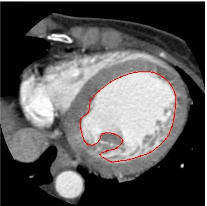 Figure 7 : Exemple de coupe d'image scanner cardiaque segmentée par l'expert pour la détection du ventricule gauche  (sans l'oreillette)