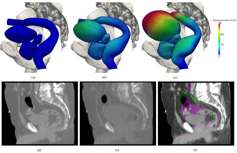 Fig. 4. (a) Initial FEM mesh of the bladder, rectum, prostate and seminal vesicles; (b) and (c): two examples of deformation induced by pressure variation in the rectum and the bladder, with surface point displacements represented by the colormap; (d) sagi