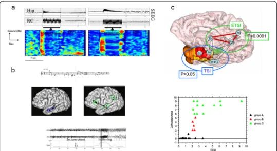 Figure 4 Different consequences of the long distance correlation changes in temporal lobe seizures