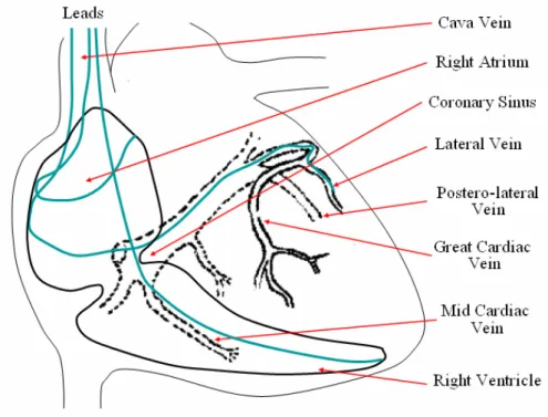 Fig. 1. Lead paths in transvenous biventricular pacing. 