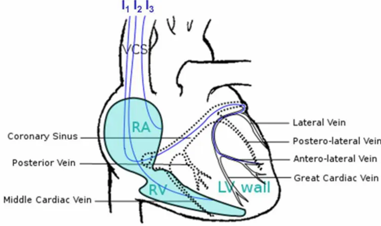 Fig. 1. Lead implantation for CRT and coronary venous anatomy on frontal view of the heart.