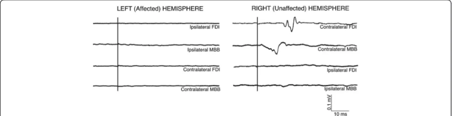 Figure 4 Topographic activation and inhibitory activity maps from the unaffected and affected sides for this patient