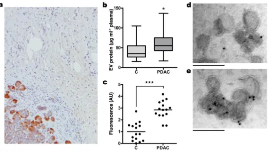 Figure 4. Reg3β-mediated EV blockage triggers Reg3β +  EV release to bloodstream in PDAC patients