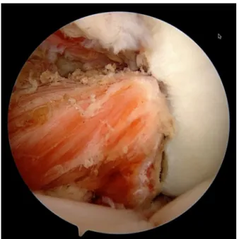 Fig. 4. Intra-articular view of acromial bone-block and deltoid pedicle.