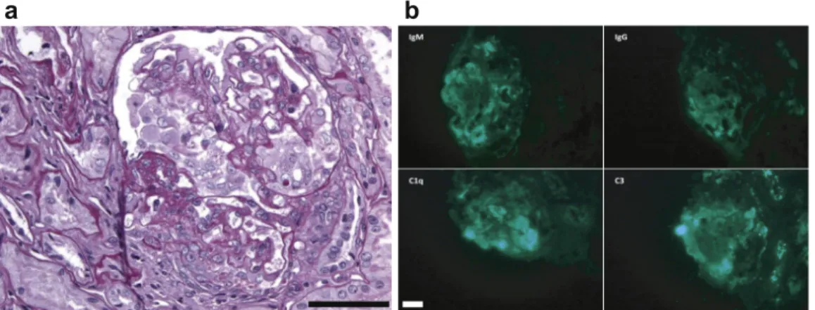 Figure 1. Kidney biopsy specimen of patient 1 (case index). (a) Proliferative lesions associated with focal and segmental glomerulosclerosis.