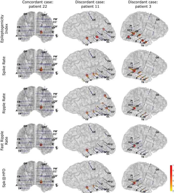 Figure 5 – Illustration of the mapping of 4 interictal markers and the EI values for 3 patients