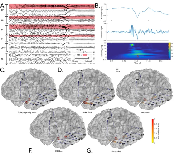 Figure 1 – Illustration of the analysis pipeline for Patient 30. (A) SEEG recording of a seizure in bipolar montage.