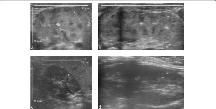 Fig. 1 Comparison of renal ultrasounds at birth (a, b) and at the age of 8 months (c, d) in a patient with propionic acidemia