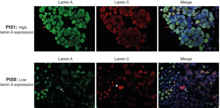Fig 2. Immunofluorescence staining of lamins A and C in cells from metastatic pleural effusions