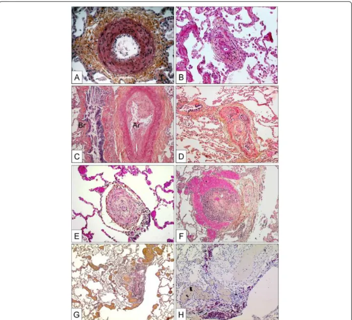 Figure 2 Pulmonary arteries of the muscular type displaying obstructive arteriopathy in lungs of patients with PAH