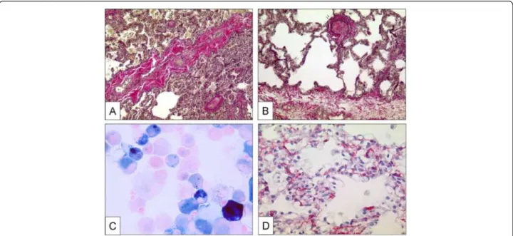 Figure 3 Pulmonary veins with obstructive venopathy in lungs of patients with PVOD and a case of pulmonary capillary hemangiomatosis